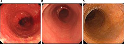 Case report: Successful treatment of ulcerative colitis-related post-colectomy enteritis refractory to multiple therapies with ustekinumab